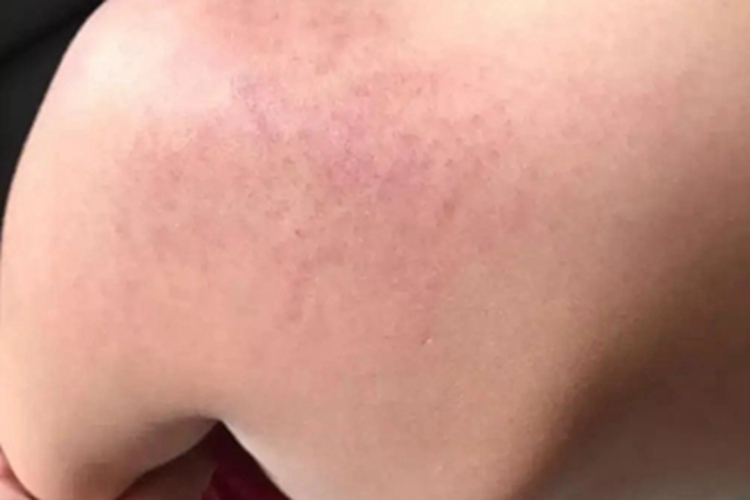 瘀斑肩部症状图