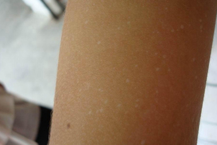 特发性滴状色素减少症症状图