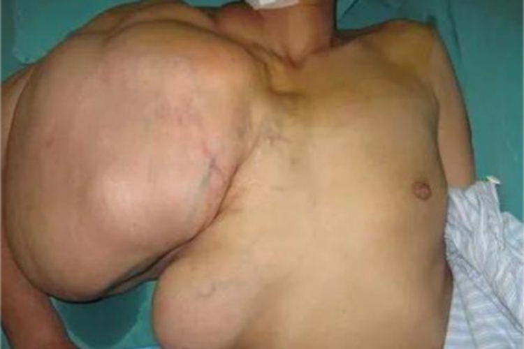 脂肪肉瘤胸部症状图