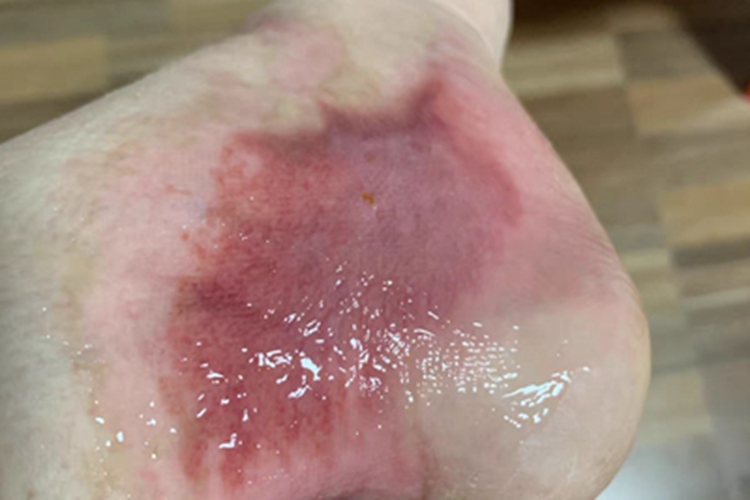 浅Ⅱ度烧伤渗液图