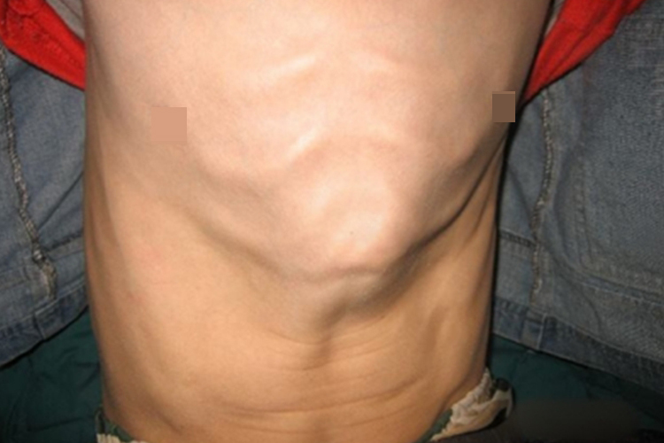 氟骨症胸前突畸形图 氟骨症胸前突畸形图