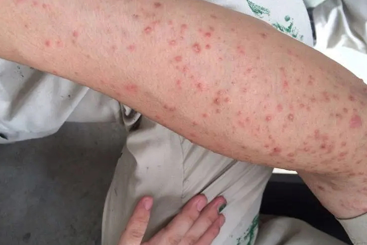 手臂硬下疳图 手臂硬下疳图