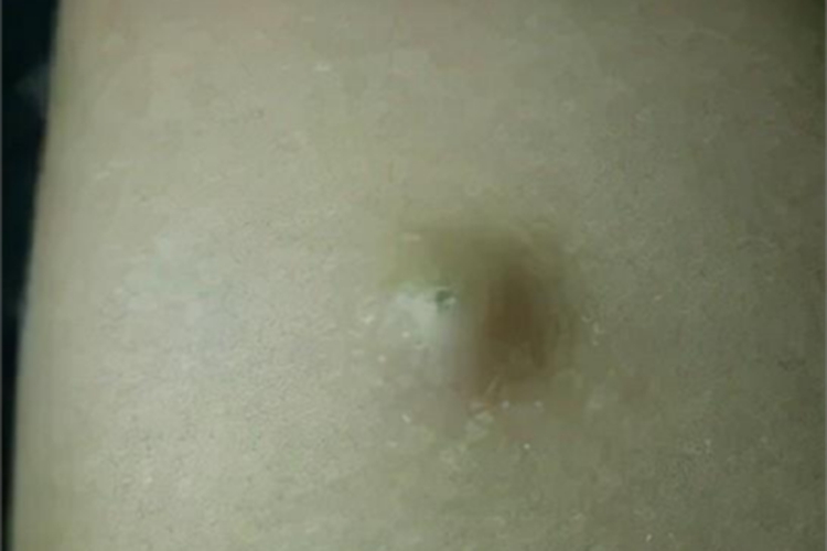 皮脂腺毛囊瘤肿块图