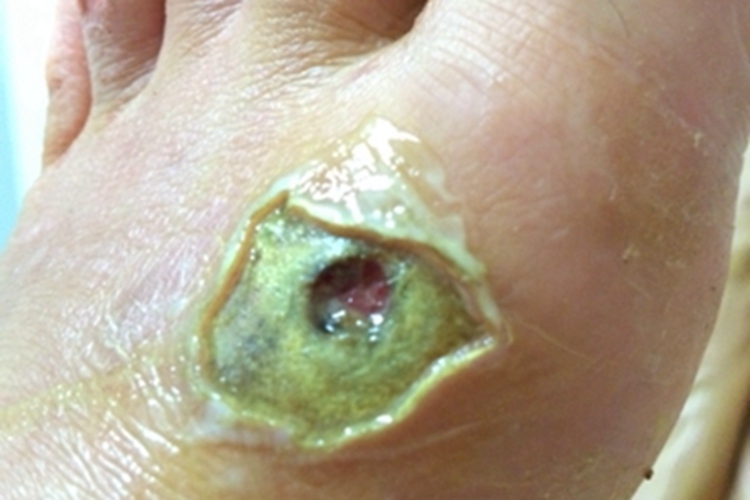 念珠状链杆菌型鼠咬热症状图