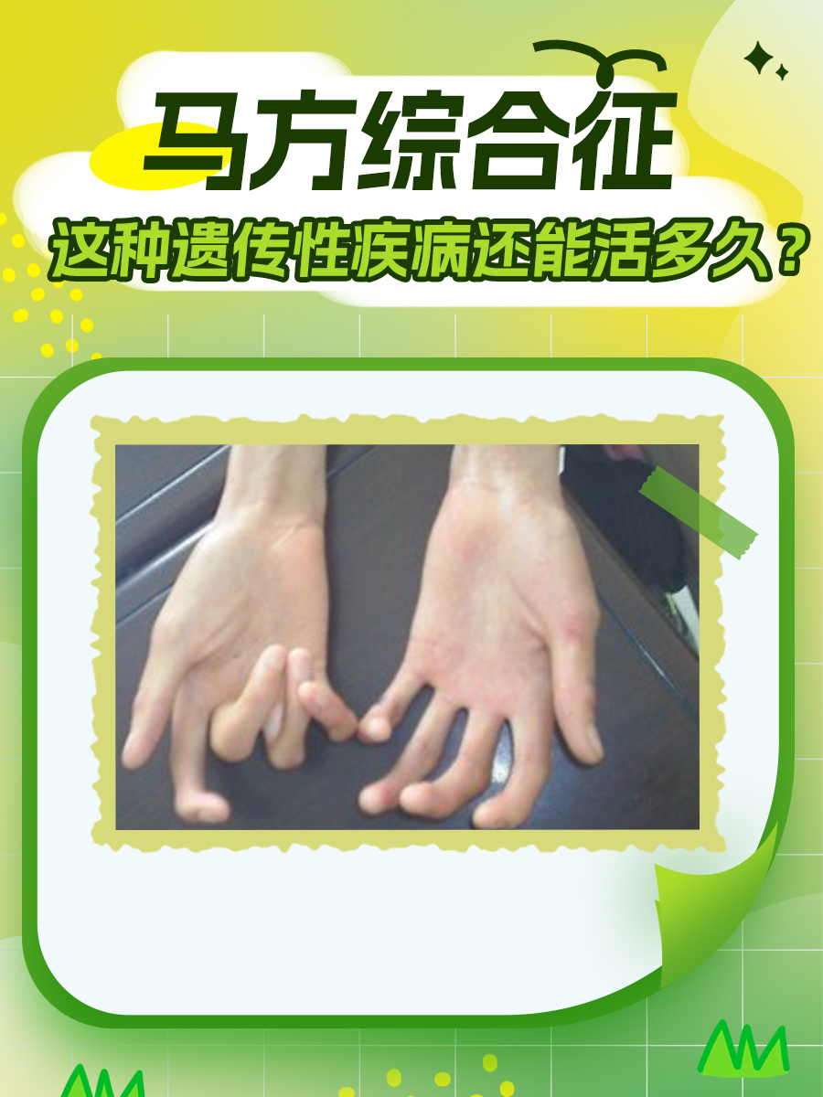 马方综合征：这种遗传性疾病还能活多久？