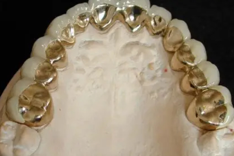 非贵金属烤瓷牙套图