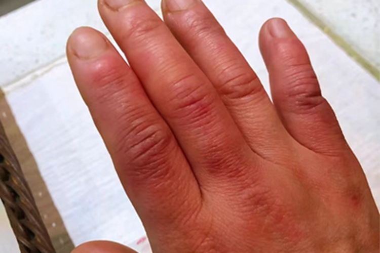 冻疮右手大范围红肿图