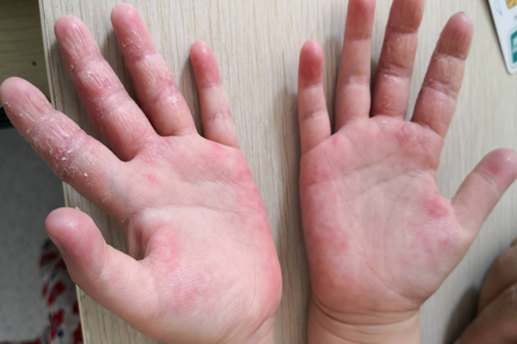 儿童特应性皮炎图 儿童特应性皮炎图