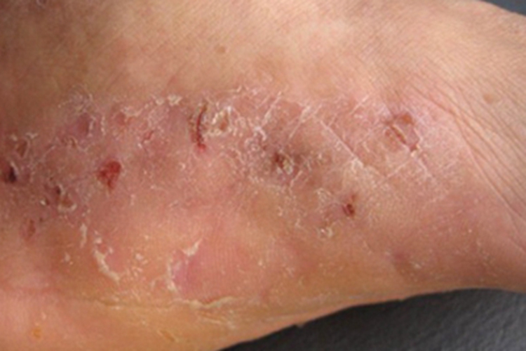 鳞屑角化型足癣脚部裂口图