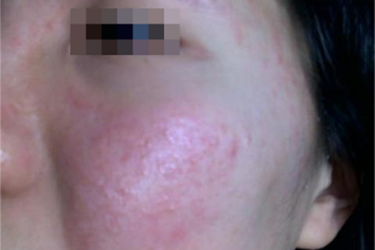 光毒性接触性皮炎面部红肿图 光毒性接触性皮炎面部红肿图