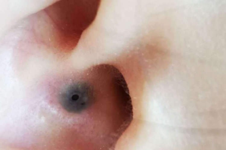 扩张孔耳部小孔图