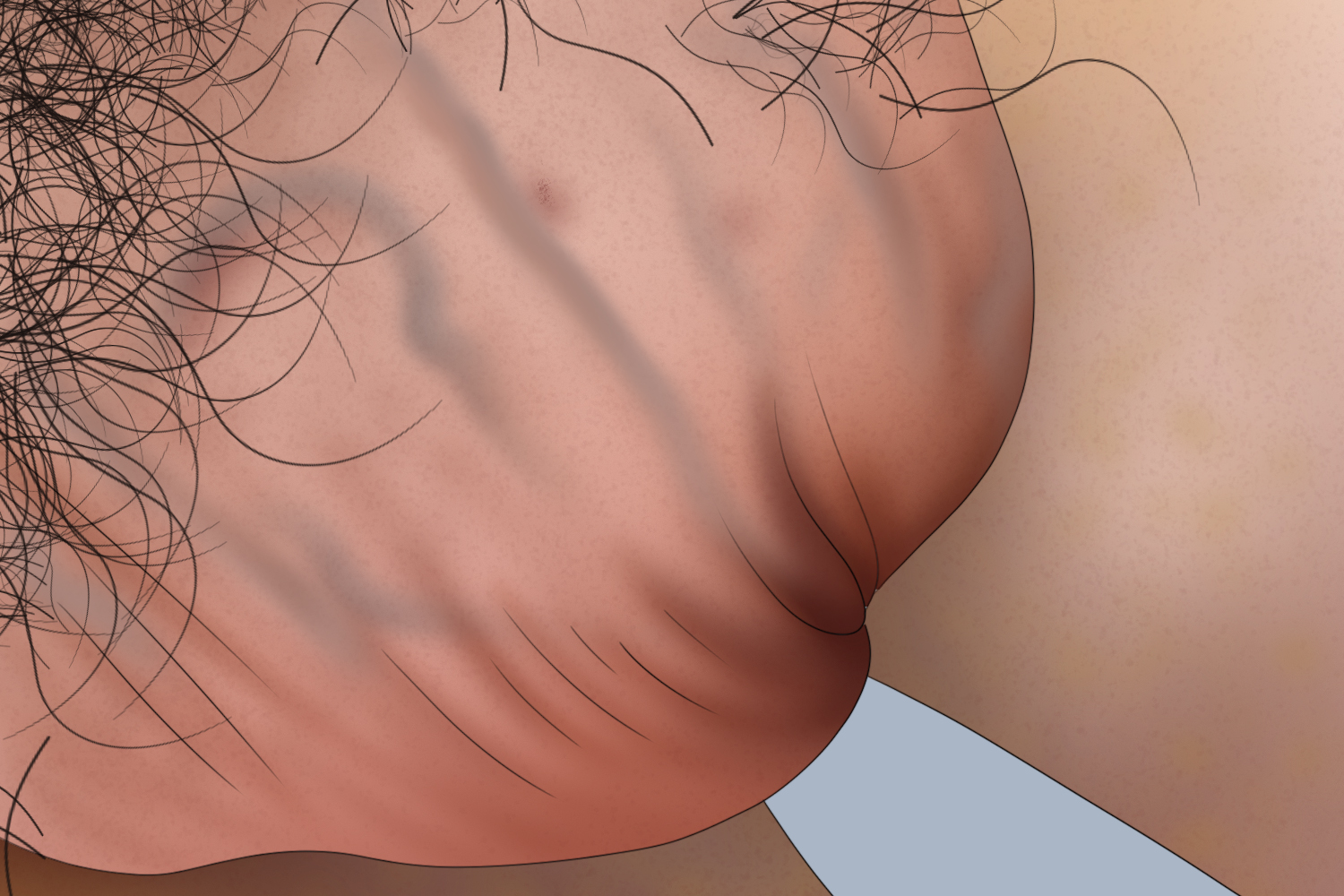 轻度精索静脉曲张手绘图 轻度精索静脉曲张手绘图