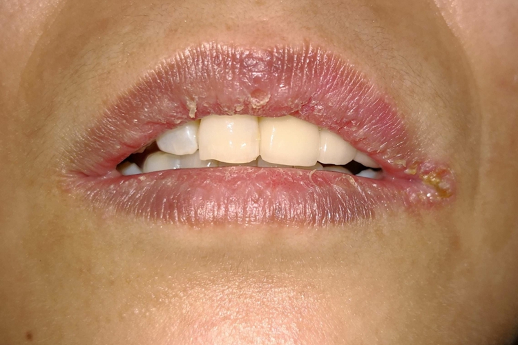 念珠菌性口角炎图