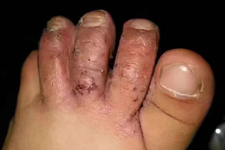 冻疮脚趾头肿胀结痂图