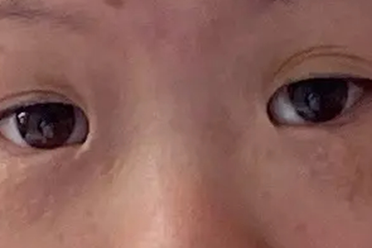 唐氏眼睛内眦赘皮图 唐氏眼睛内眦赘皮图