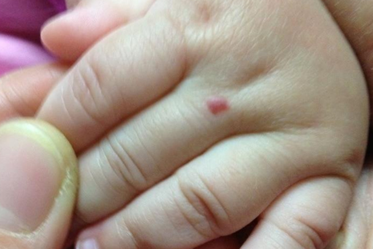 血管瘤最开始小红点图