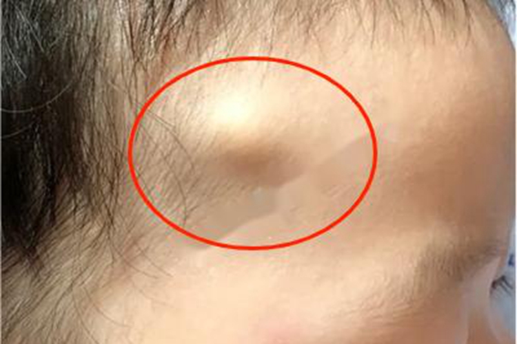 皮样囊肿囊肿图 皮样囊肿囊肿图