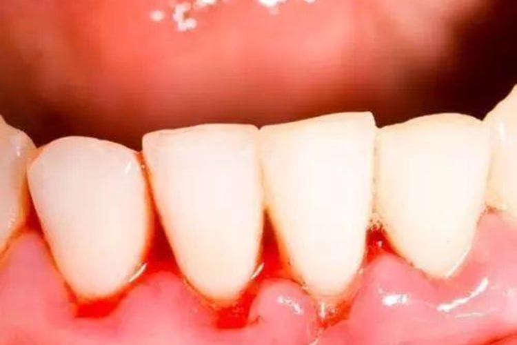 局限型侵袭性牙周炎牙龈血丝图