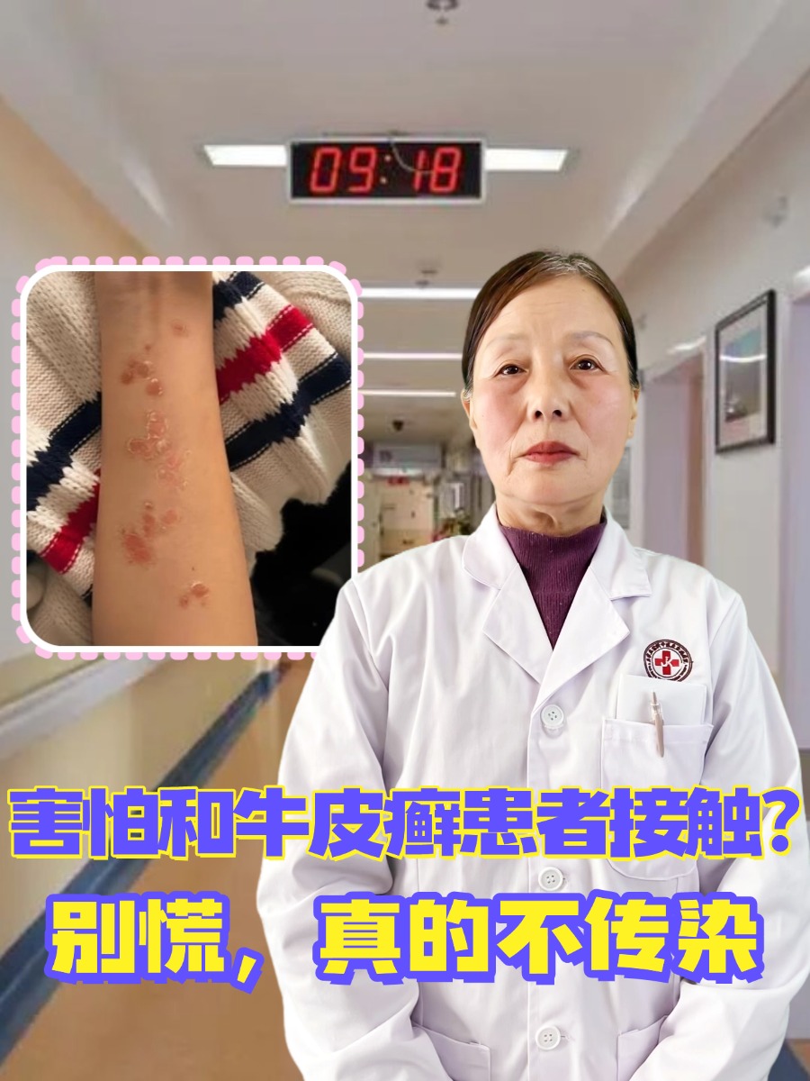 害怕和牛皮癣患者接触？别慌，真的不传染