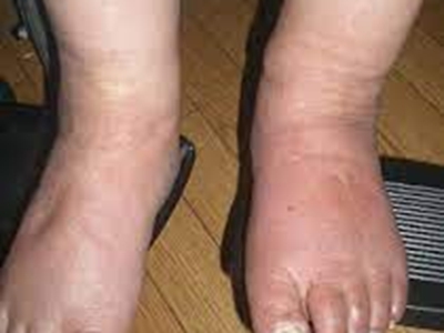 闭塞性动脉硬化症脚部水肿按压有凹坑图.jpg