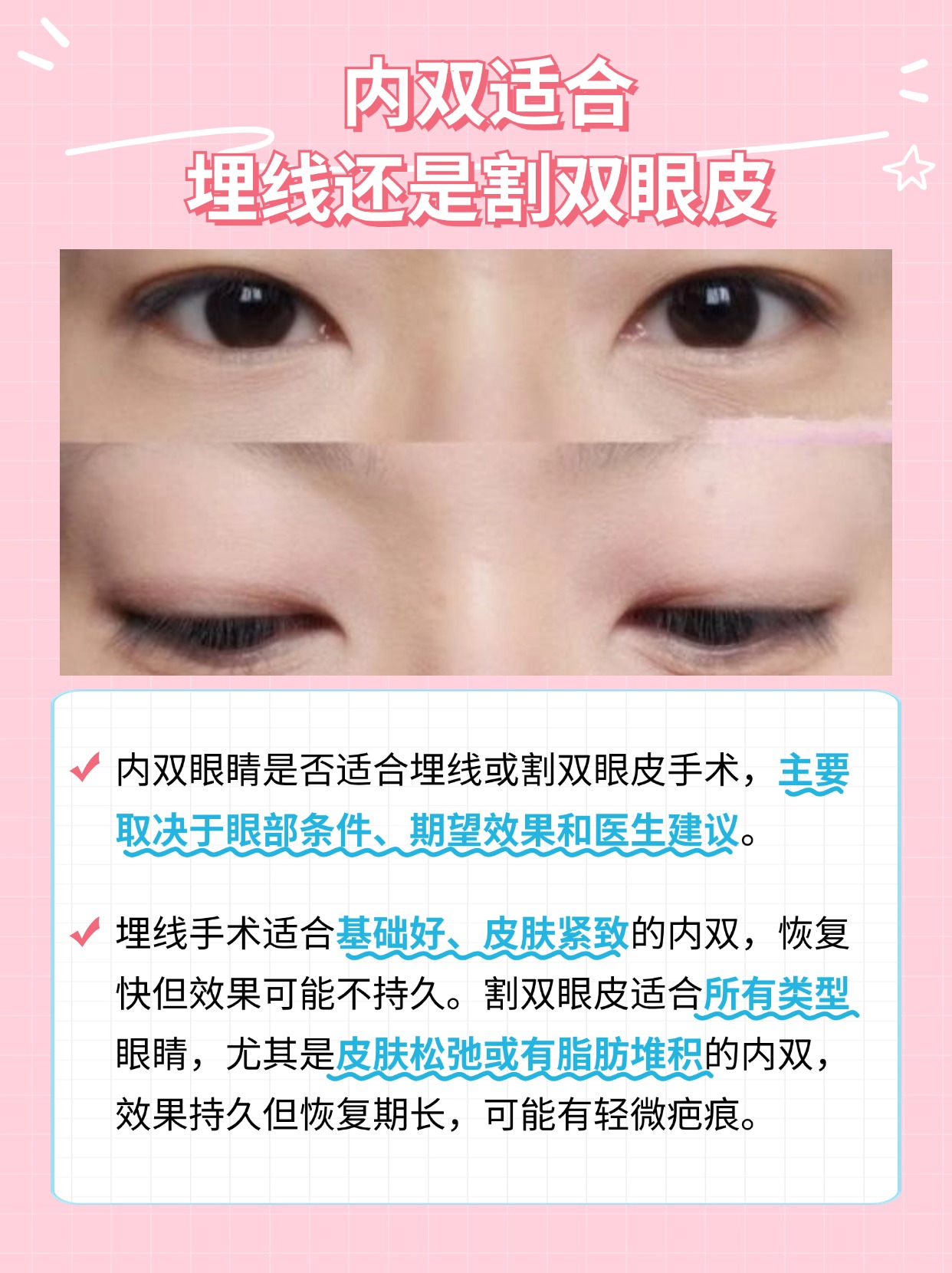内双埋线or割双眼皮,专家教你如何选择!