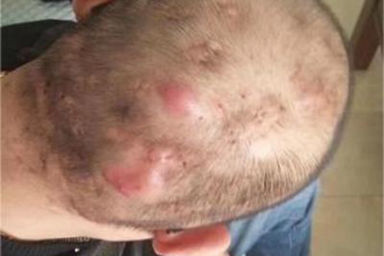 细菌性毛囊炎头皮大包图