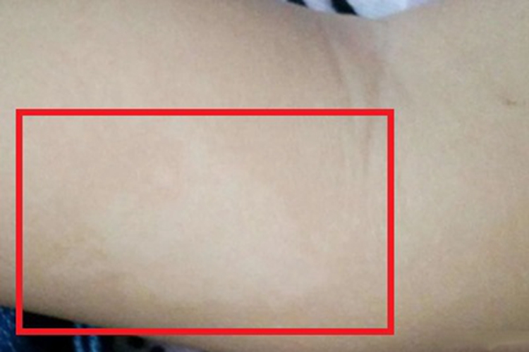 脱色素性痣胳膊症状图