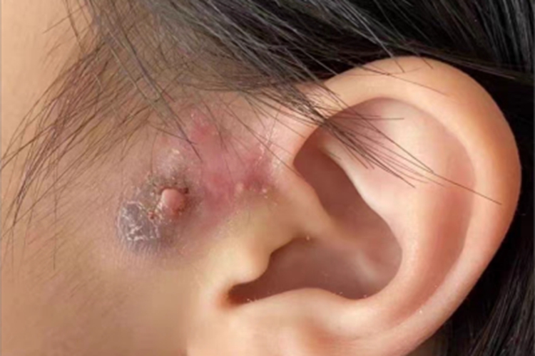 瘢痕疙瘩耳前有肉疙瘩图