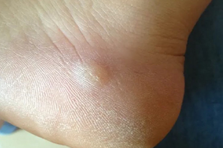 脚长摩擦水疱图