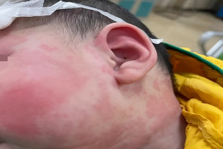 婴儿奶粉过敏脸图