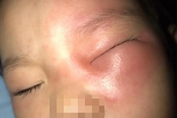 昆虫性皮炎眼部红肿图 昆虫性皮炎眼部红肿图