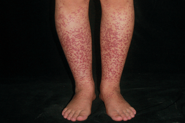 过敏性紫癜图 过敏性紫癜图