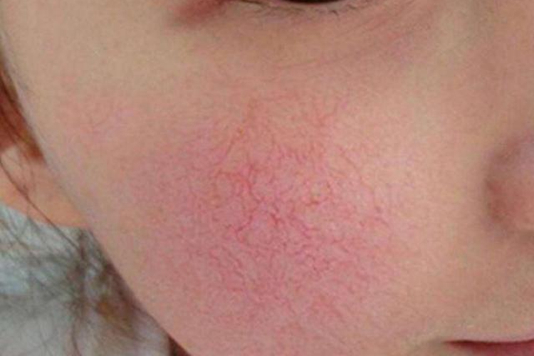 小孩脸上毛细血管明显图