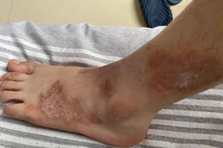 湿疹脚背脱屑图 湿疹脚背脱屑图