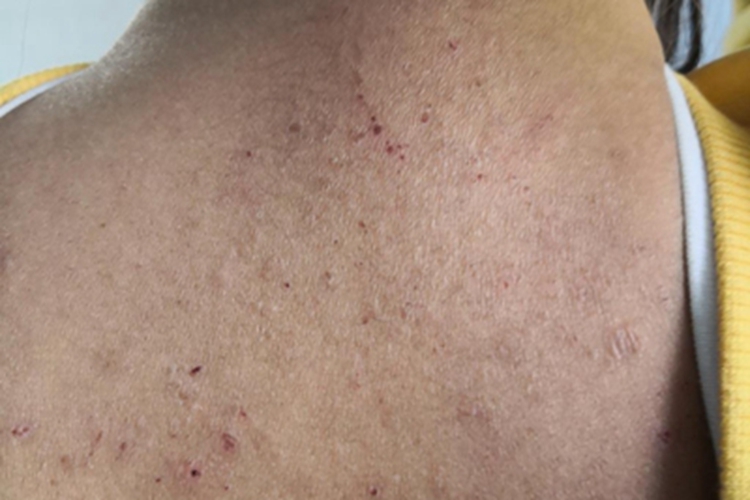 干性湿疹背部血痂图