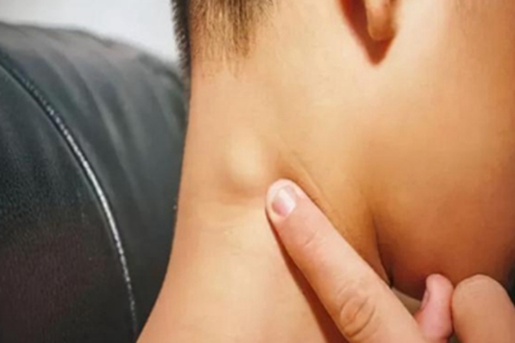 表皮样囊肿颈部症状图