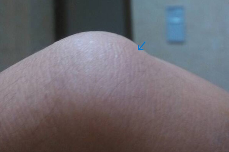 宝宝膝盖腱鞘囊肿图