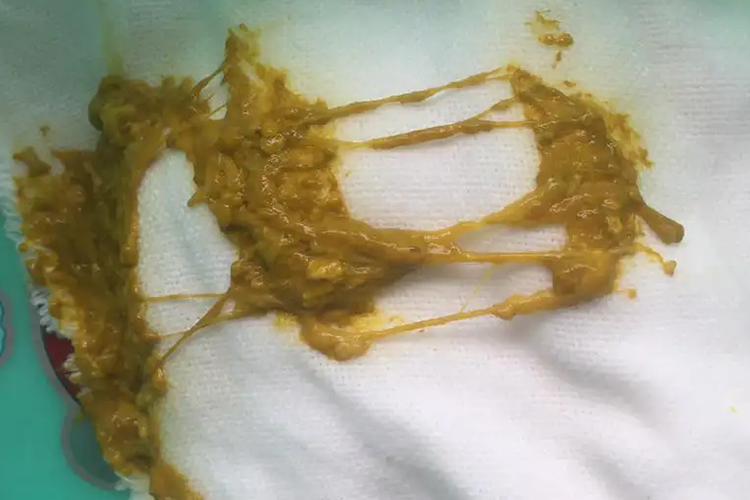 胃肠炎宝宝大便图