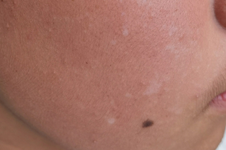 白色糠疹面部出现白块图