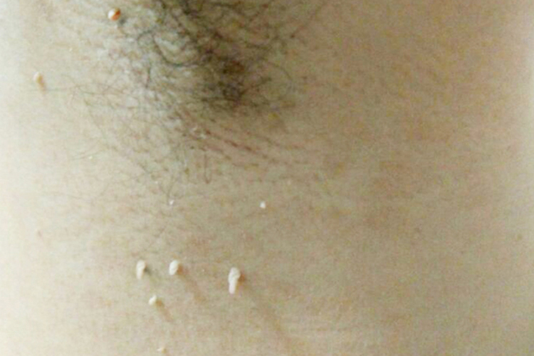 腋下丝状疣图 腋下丝状疣图