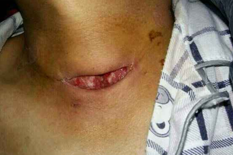 鳃裂瘘感染并发甲状腺炎图