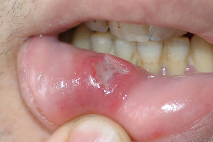 红斑狼疮早期黏膜糜烂图