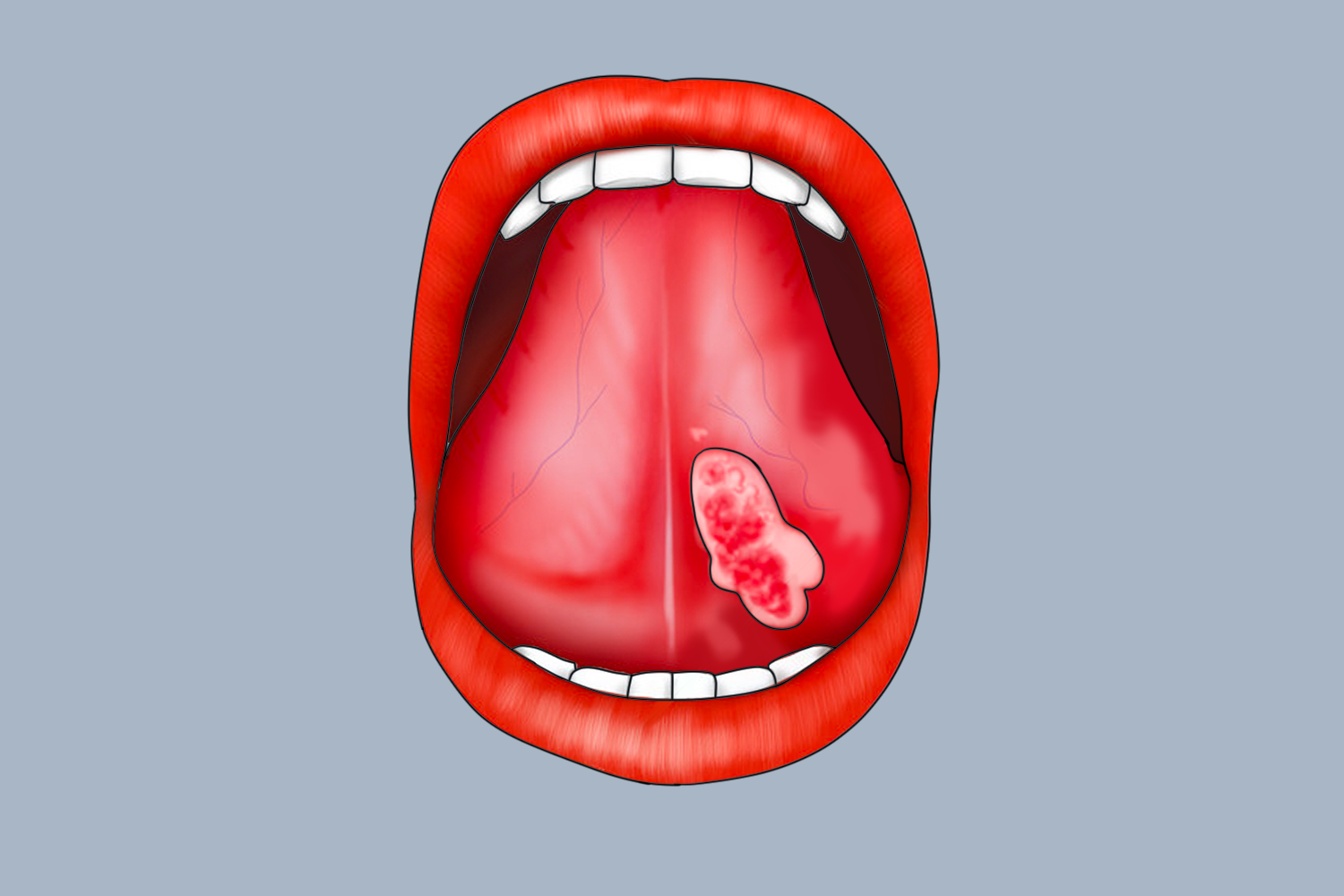 舌下腺癌图片