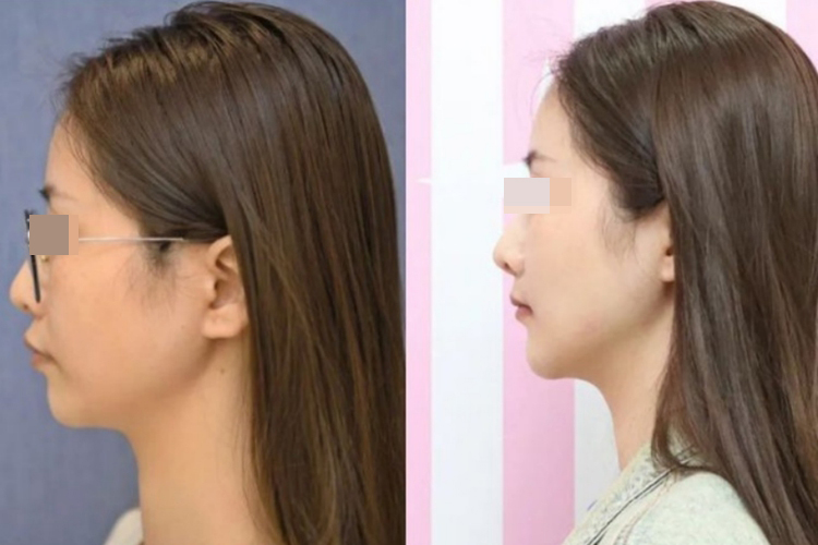 双颌前突矫正对比图