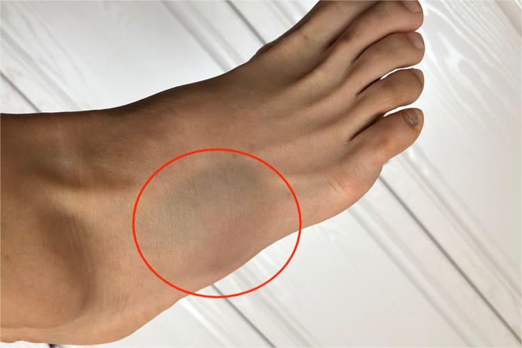 第5跖骨基底部骨折肿胀图