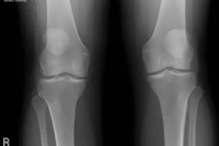 骨软化症影像图 骨软化症影像图