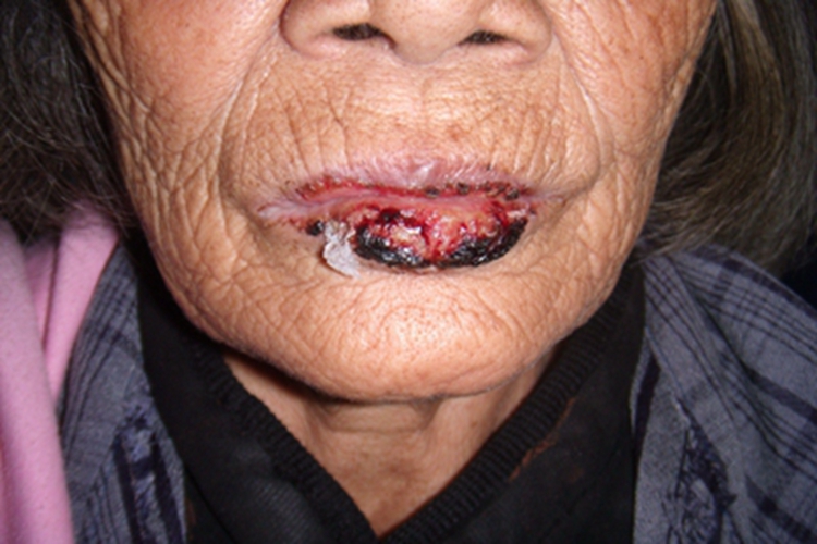 急性光化性唇炎嘴唇糜烂图