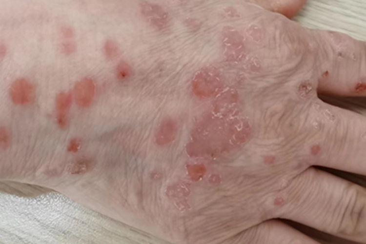 寻常型银屑病手背红斑脱皮图