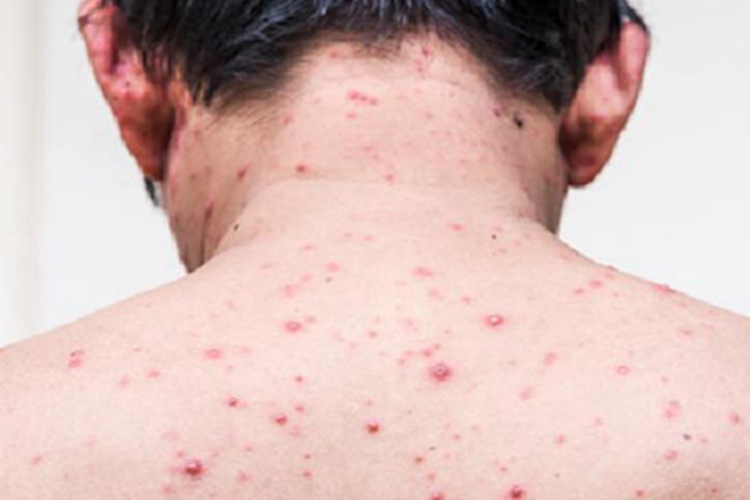 松毛虫皮炎背部症状图 松毛虫皮炎背部症状图