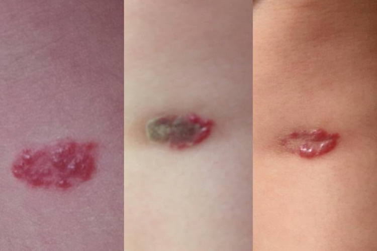 血管瘤激光治疗过程图 血管瘤激光治疗过程图